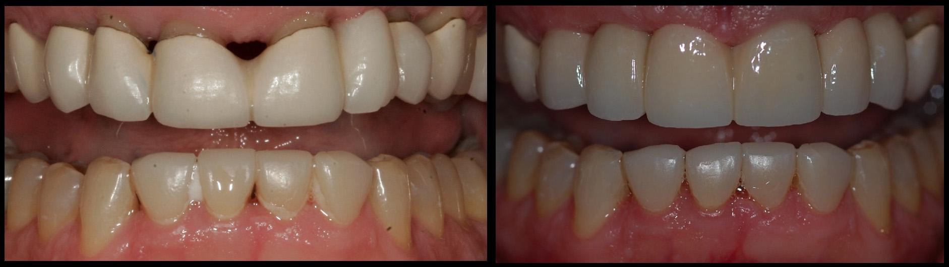 dental implant treatment by Mae Lee Springer, DDS